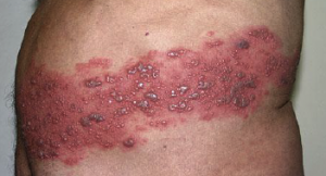 herpes zoster